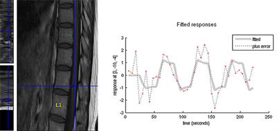 Lumbar Spinal Cord Activity and Blood Biochemical Changes in Individuals With Diabetic Peripheral Neuropathy During Electrical Stimulation